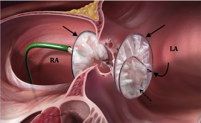 Gore helex septal occluder mri safety